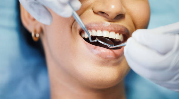 Best Knocked-Out Tooth (Avulsed Tooth) Treatment in Uintah, UT